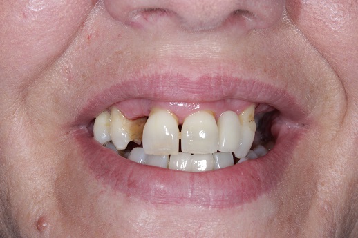 before dental implants